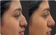 قبل و بعد فیلر بینی