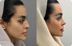 قبل و بعد جراحی بینی